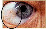 Pterygium example