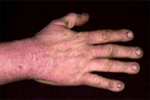 Tobacco Skin Irritations